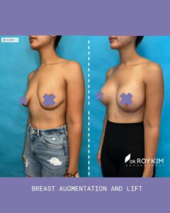 breast lift