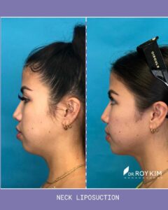 neck liposuction