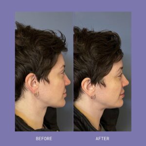 before and after lip filler