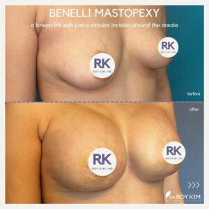 benelli mastopexy