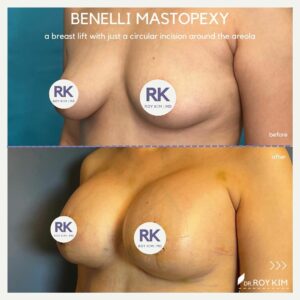 benelli mastopexy