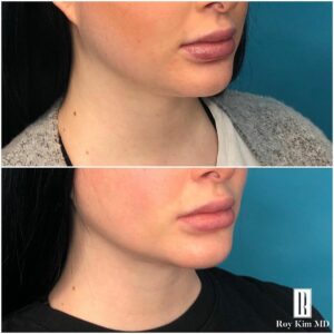 Before and After Chin Liposuction
