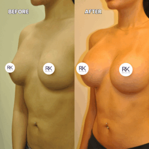 Breast Augmentation Before and After: 450 cc High Profile Silicone Implants
